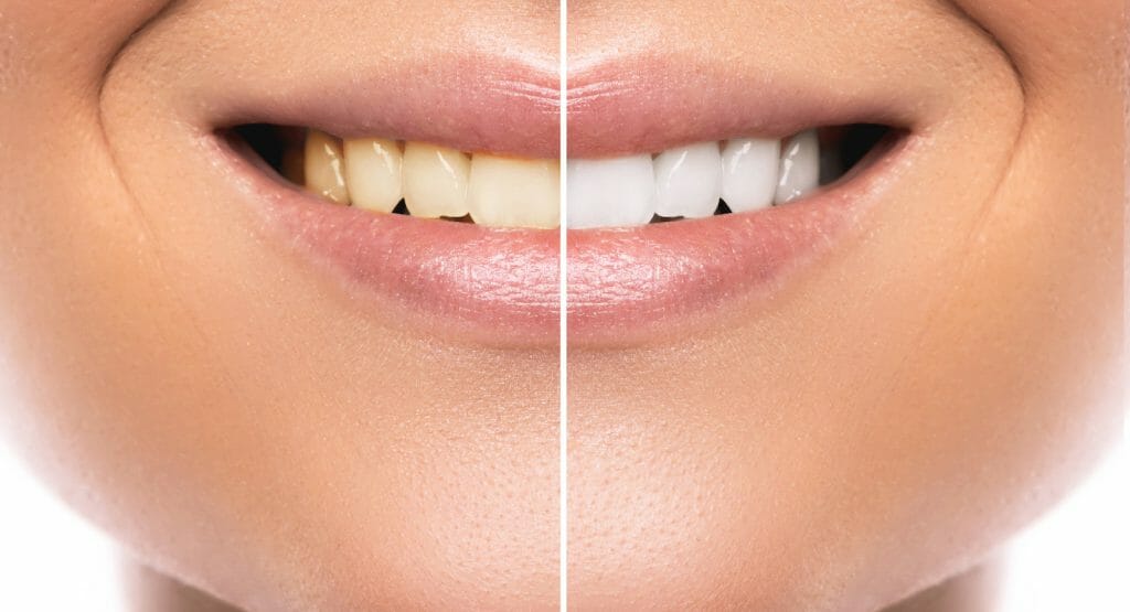 teeth whitening before & after