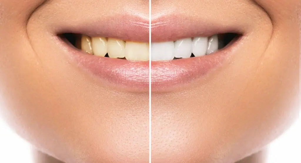 teeth whitening before & after